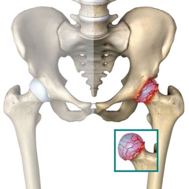 arthrosis na hip hadin gwiwa
