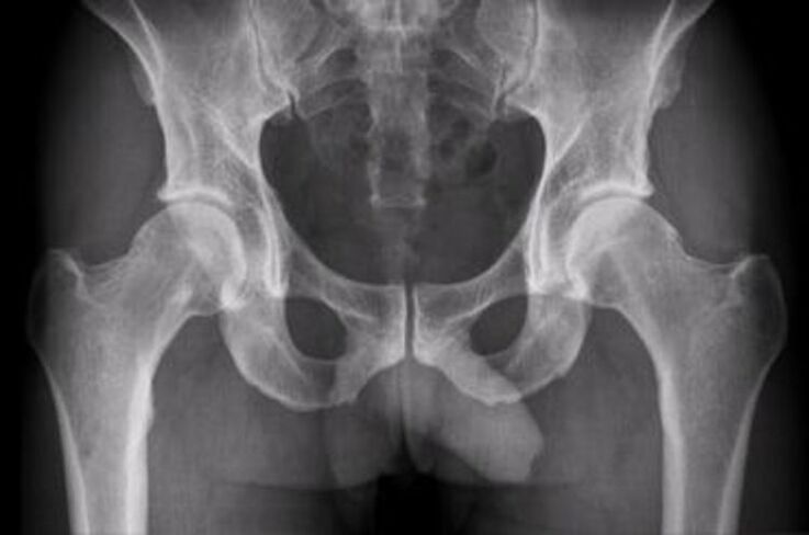 x-ray na haɗin gwiwa na hip don ciwo