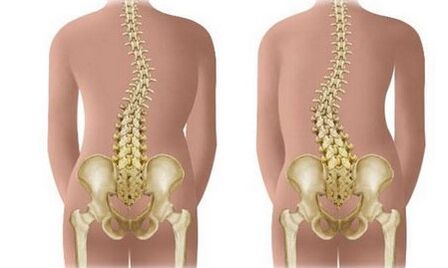 Ba mai scoliosis ba