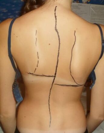 Baki hump