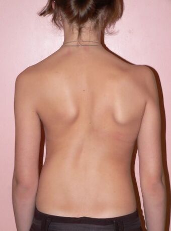 Scoliosis 2 digiri