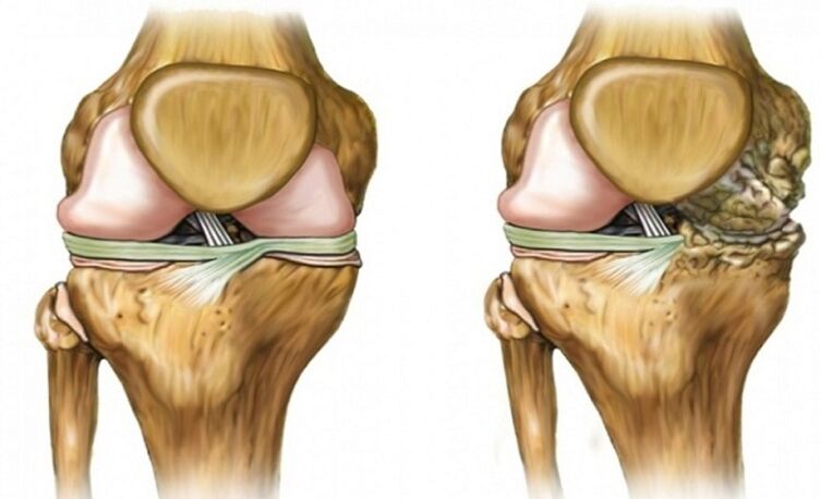 Lafiya da cutar ta Arthrosis hadin gwiwa