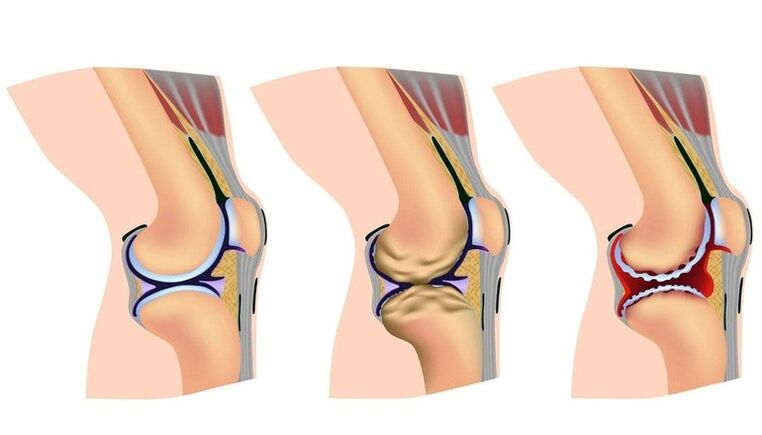 Matakai na lalata a cikin gwiwa hadin gwiwa don Arthrosis