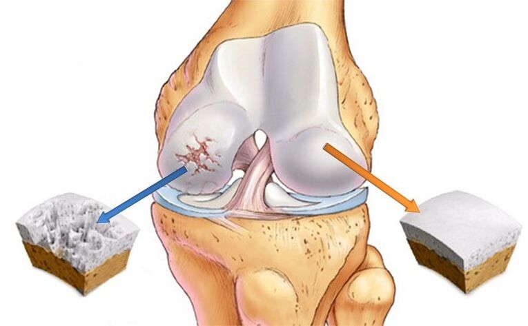Tarihin al'ada na yau da kullun da na Arthrosis