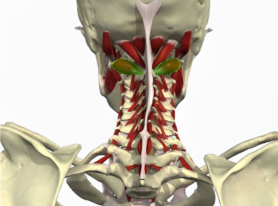 vertebral artery ciwo