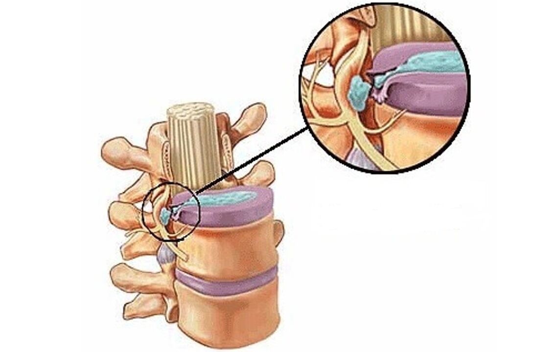 intervertebral hernia tare da thoracic osteochondrosis