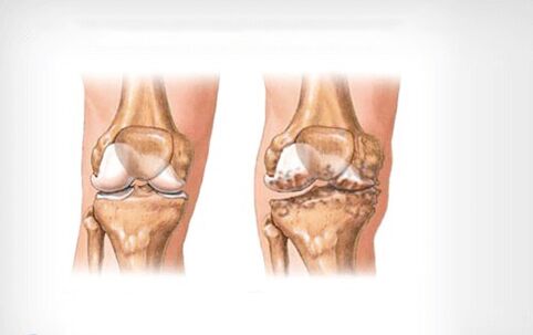 arthrosis na gwiwa gwiwa