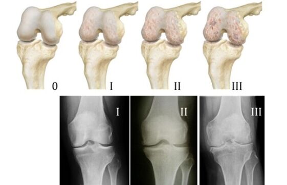 hanyoyin da za a bincikar arthrosis na gwiwa