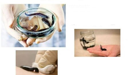 hirudotherapy don arthrosis