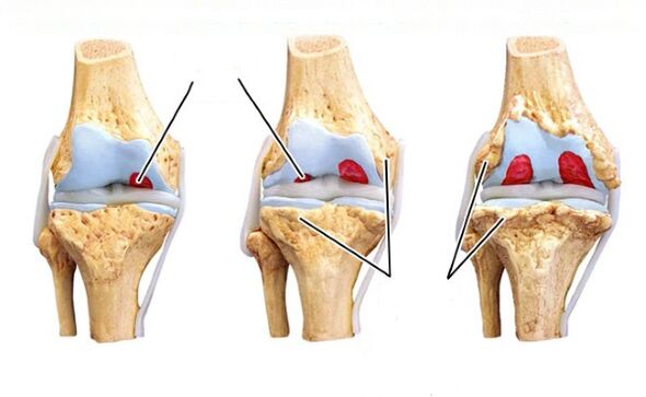 matakai na gwiwa arthrosis